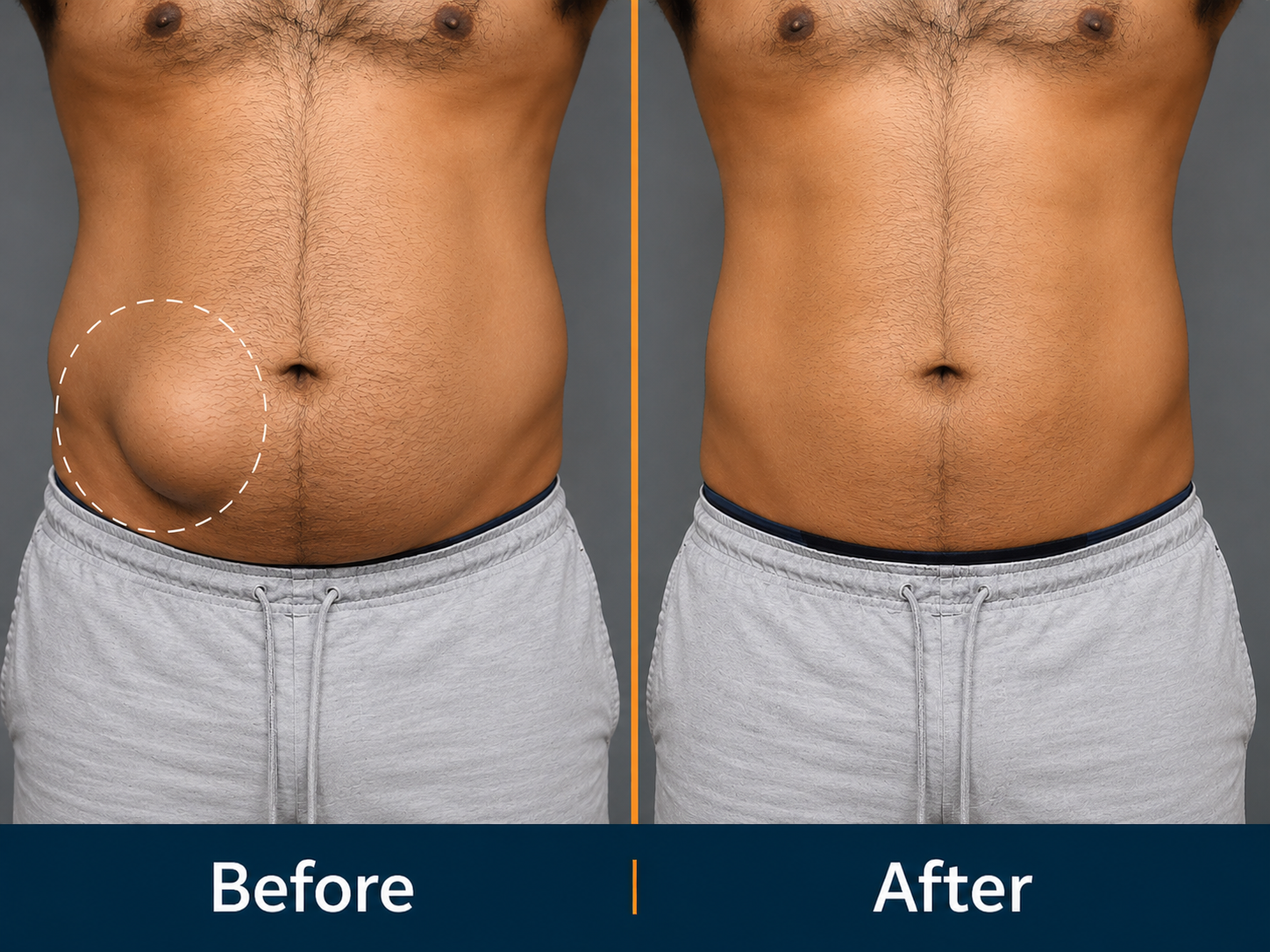 Before and After Laparoscopic Hernia Repair